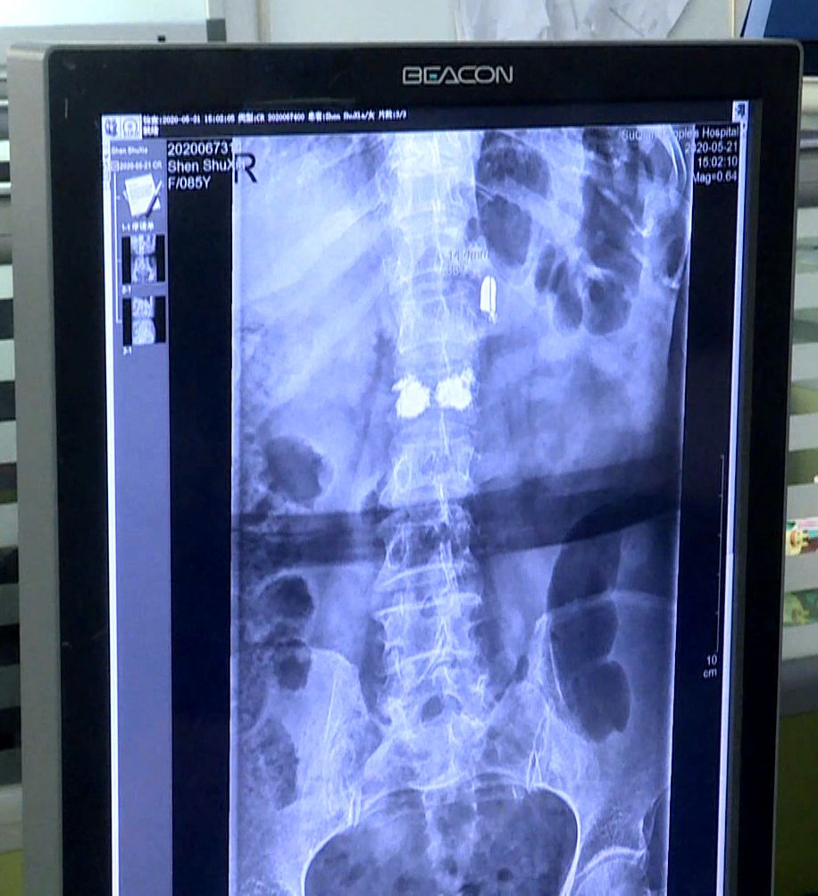 社会万象85岁老人体内发现80年前日军子弹 见证当年血泪史