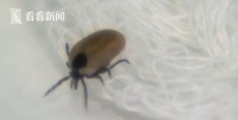 蜱虫|三岁女童感觉有耳朵内异物，竟是蜱虫在里面产卵