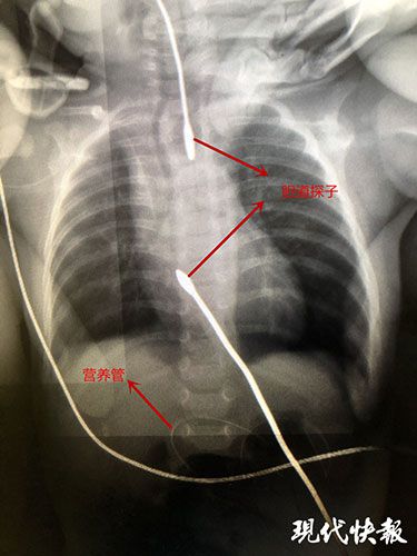 螃蟹揪心！“螃蟹宝宝”一出生做了三次手术，次次险致命