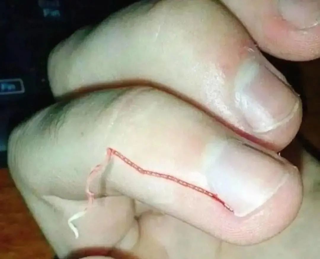 tvb女星拔倒刺上了手术台手贱一时爽拔完泪汪汪