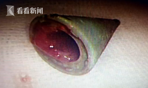 |男子每天咳血15毫升 竟和20年前的一个笔头有关