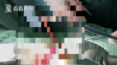 腹膜高烧腰疼半年 男子手术取出5厘米牙签已戳穿腹膜