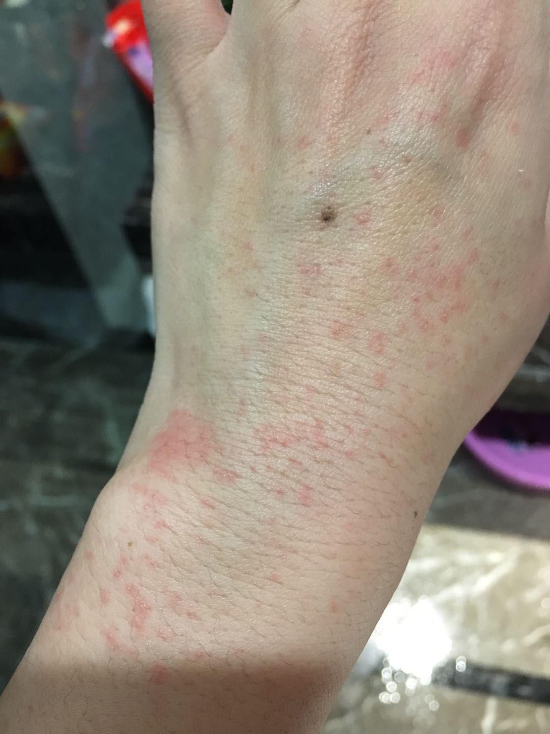 奋战在疫情前线,一名医护人员一个班次下来需要洗手,涂抹消毒液多达40