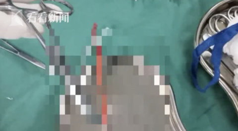 腹膜高烧腰疼半年 男子手术取出5厘米牙签已戳穿腹膜