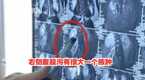 腹膜高烧腰疼半年 男子手术取出5厘米牙签已戳穿腹膜
