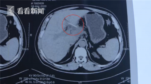 「养生」男子吞入牙签浑然不知 检查时已扎进肝脏