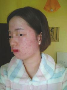 　治疗后，陈敏脸上的痘痘并没有消除，反而变得更严重。