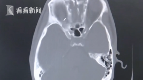 [养生]小伙出门吃宵夜醒来躺在医院失忆了 真相竟是…