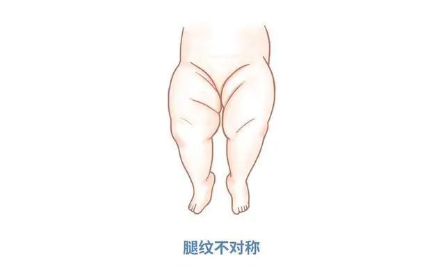 婴儿腿纹不对称图片图片