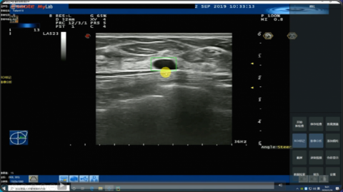 人工智能|中关村科学城企业研发全国首个“AI超声”检测系统