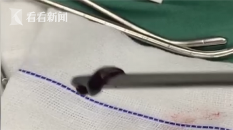 蚂蝗|男子反复咳血四年 检查结果让所有人大吃一惊！