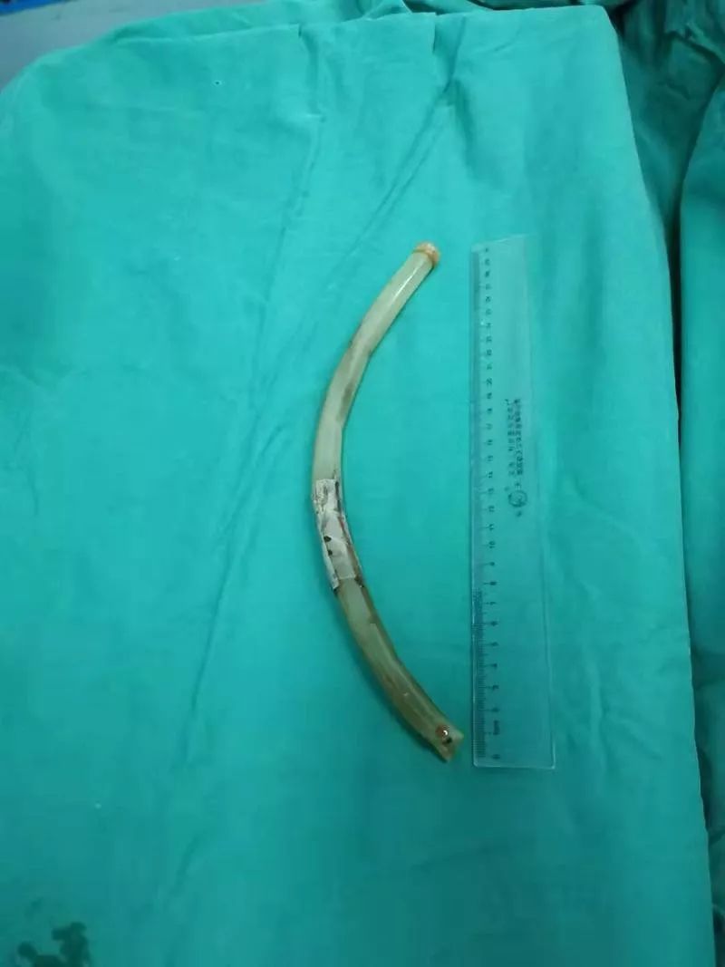 女孩就诊称喝奶茶误吞吸管医生取出30cm长催吐管