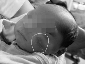 　■宝宝刚出生脸就被“毁容”。本报记者 王铎 摄