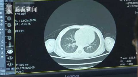 羊奶|2岁女童喝现挤羊奶患上“布病”！医生紧急提醒