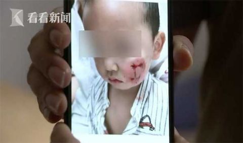 |吓人！2岁男童被黑狗袭击 脸部被咬伤齿痕明显