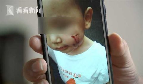 |吓人！2岁男童被黑狗袭击 脸部被咬伤齿痕明显