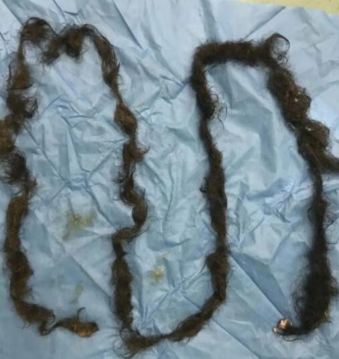 畸胎瘤|女子腹中取出2米多长头发！工作38年的医生：从来没见过