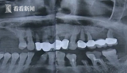 |修复烤瓷牙却被拔3颗真牙？患者：医生只顾聊天