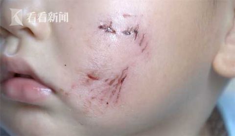 |吓人！2岁男童被黑狗袭击 脸部被咬伤齿痕明显